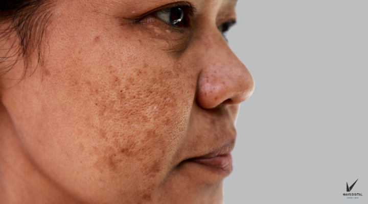 melasma